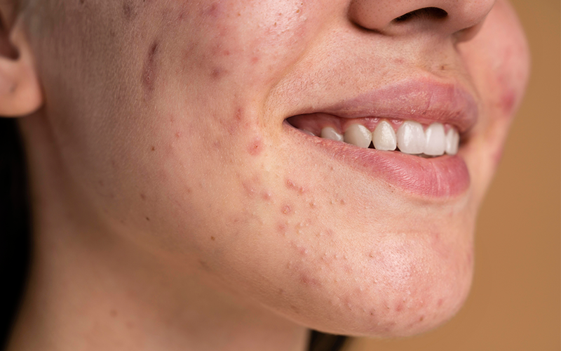 Hangi Cilt Tipinde Sivilce Çıkar,&nbsp;Konya cilt bakımı, Peeling hizmetleri Konya, En iyi peeling merkezleri Konya, Konya'da profesyonel cilt yenileme, Kimyasal peeling Konya, Doğal peeling yöntemleri Konya, Konya'da yüz peeling uzmanları, Cilt tedavisi Konya, Konya'da güzellik ve cilt bakımı, Mikrodermabrazyon Konya, Konya'da dermatoloji klinikleri, Yüz gençleştirme Konya, Konya cilt yenileme teknikleri, Cilt pürüzsüzleştirme Konya, Konya'da medikal estetik hizmetleri, Cilt sağlığı uzmanları Konya, Cilt lekeleri tedavisi Konya, Konya güzellik merkezleri, Cilt gençleştirme fiyatları Konya, Konya'da estetik cilt bakımı,