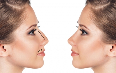 Konya Burun Dolgusu: Ameliyatsız Burun Estetiğinde Doğal Çözümler